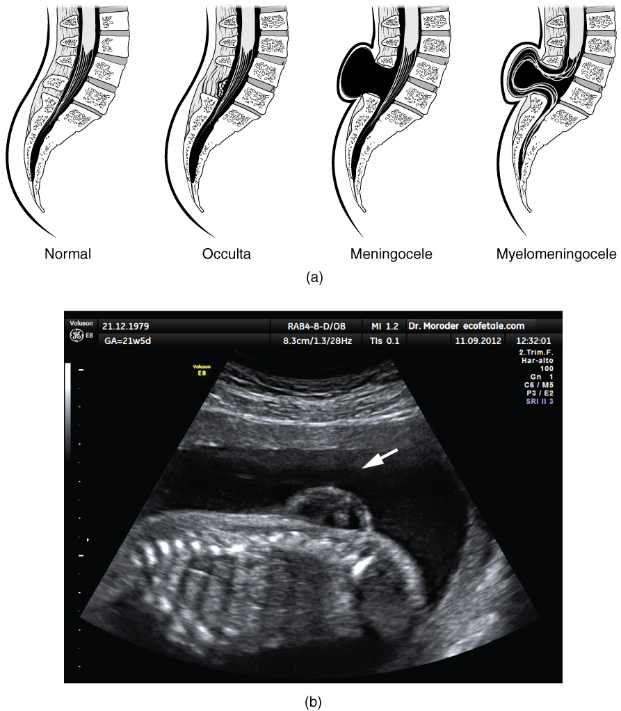 This figure shows the spinal cord in spina bifida, a birth defect. In the top panel, four different spinal cords are shown. The leftmost panel shows a normal spinal cord. The remaining panels show the spinal cord in various stages of spina bifida. The bottom panel shows an ultrasound image, with a white arrow showing the region of the defect.