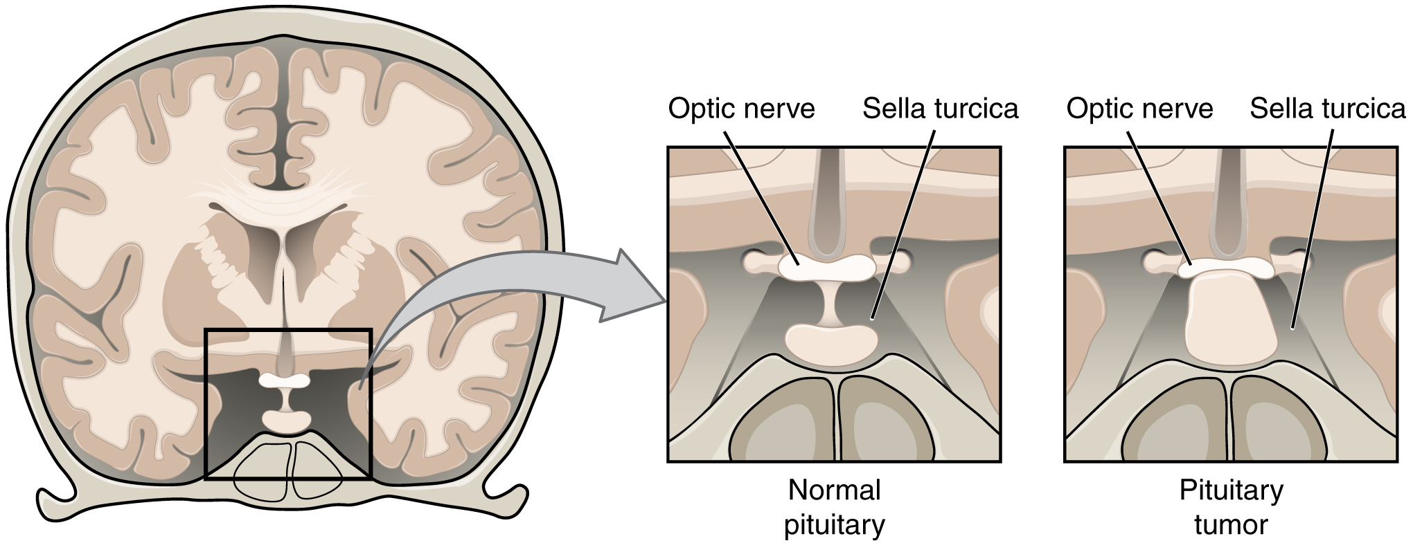 The left panel of this figure shows the top view of the brain. The center panel shows the magnified view of a normal pituitary, and the right panel shows a pituitary tumor.