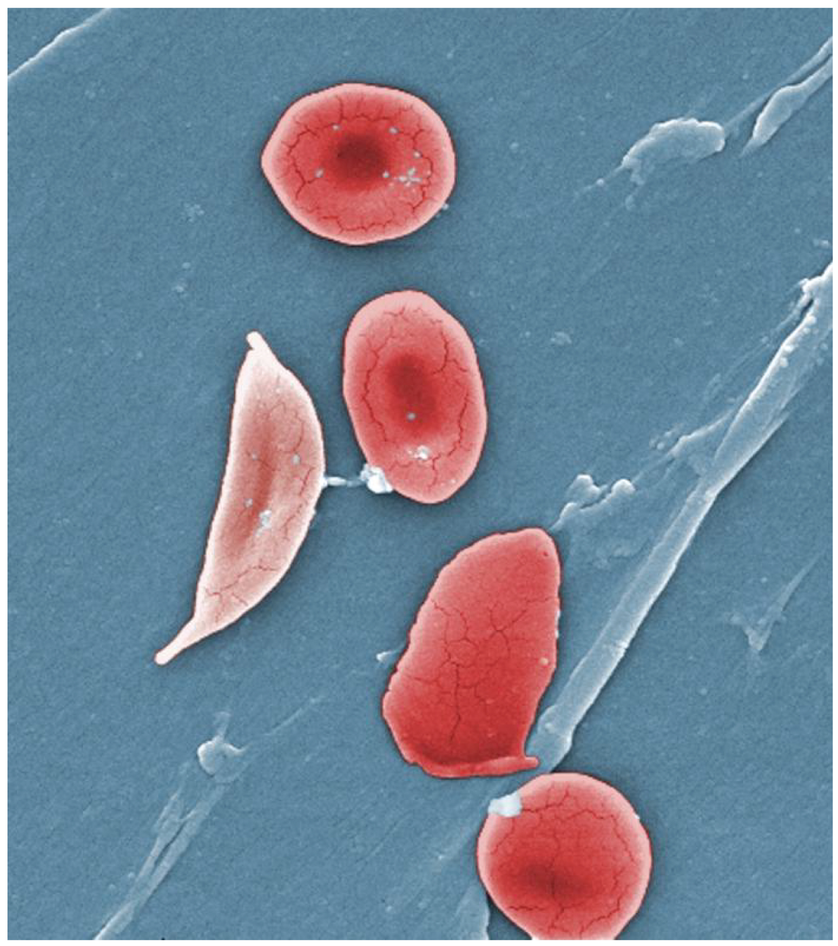 This photograph shows red blood cells of a person suffering from sickle cell anemia. Instead of being discoid shaped like healthy blood cells, sickle red blood cells are shaped like a sickle.