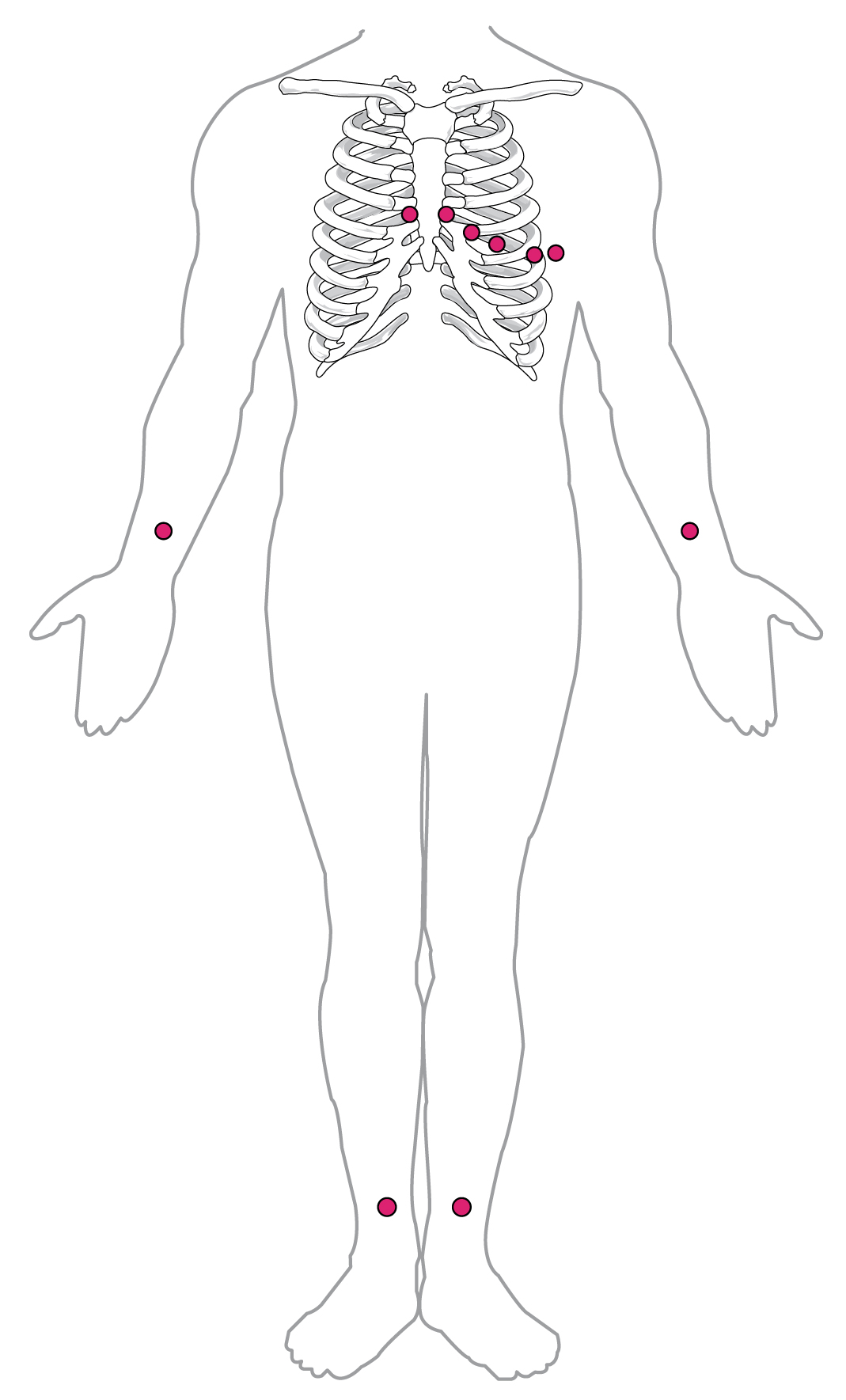 This diagram shows the points where electrodes are placed on the body for an ECG.