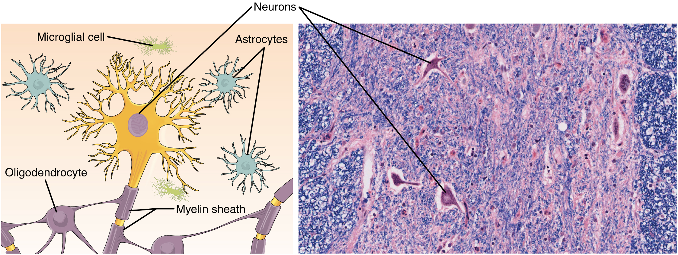 Part A of this diagram shows various types of nerve cells. The largest cell is a neuron. The central body of the neuron contains a single nucleus. Six sets of dendrites project from the top, left and right, edges of the neuron. The dendrites are yellow and branch many times after leaving the cell, taking on the appearance of tiny trees. The axon projects from the bottom edge of the cell and is covered with purple sheaths labeled the myelin sheath. The sheath is not continuous, but instead is a series of equally spaced segments along the axon. Another cell, called an oligodendrocyte, is spider like in appearance, with its leg-like projections each connecting to a segment of the neuron’s myelin sheath. Above the neuron are three astrocytes. They are much smaller than the neuron and have no axons, and are also irregularly shaped cells with many dendrites projecting from the central body. Finally, a microglial cell is shown above the neuron. It is the smallest of the cells in this figure and is an elongated cell with many fine, tentacle-like projections. The projections are concentrated at the two ends of the cell, with the middle area lacking any projections. The micrograph of the neural tissue shows that this tissue is very heterogenous, with both large and small cells embedded in the matrix. Much of the space between the cells is occupied by threadlike nerve fibers.