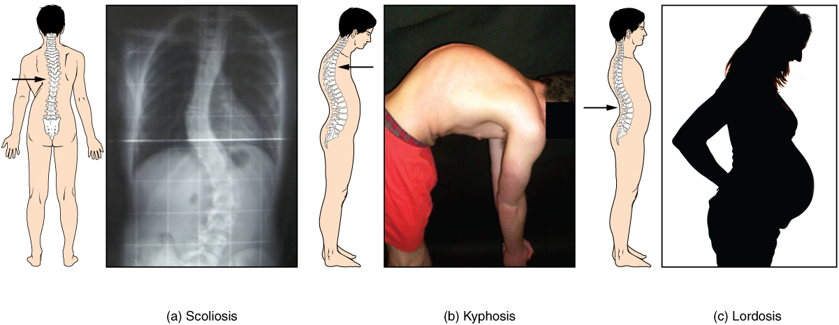 This image shows the changes to the abnormal curves of the vertebral columns in different diseases. The left panel shows the change in the curve of the vertebral column in scoliosis, the middle panel shows the change in the curve of the vertebral column in kyphosis, and the right panel shows the change in the curve of the vertebral column in lordosis.