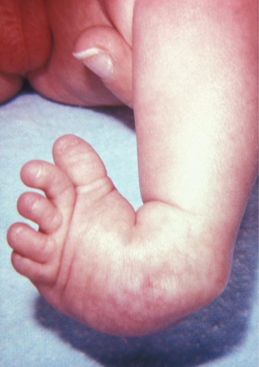 This photograph shows a baby with a clubfoot.