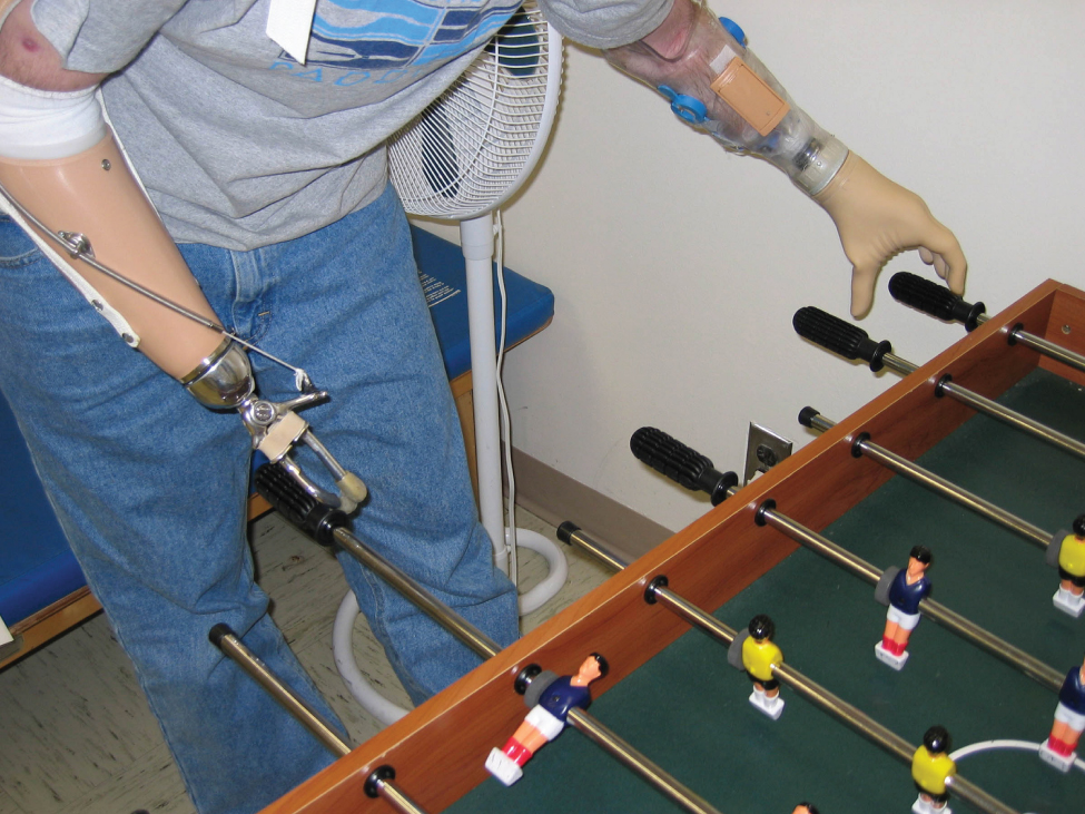 This photo shows a person playing foosball. The person has had both of their lower arms amputated. The left arm was replaced with a replica of a human hand and the right arm was replaced with a manipulator that resembles a pair of tongs.