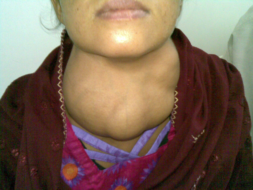 This photo shows a woman with a goiter, which is an extreme, irregular swelling on the anterior side of the neck.
