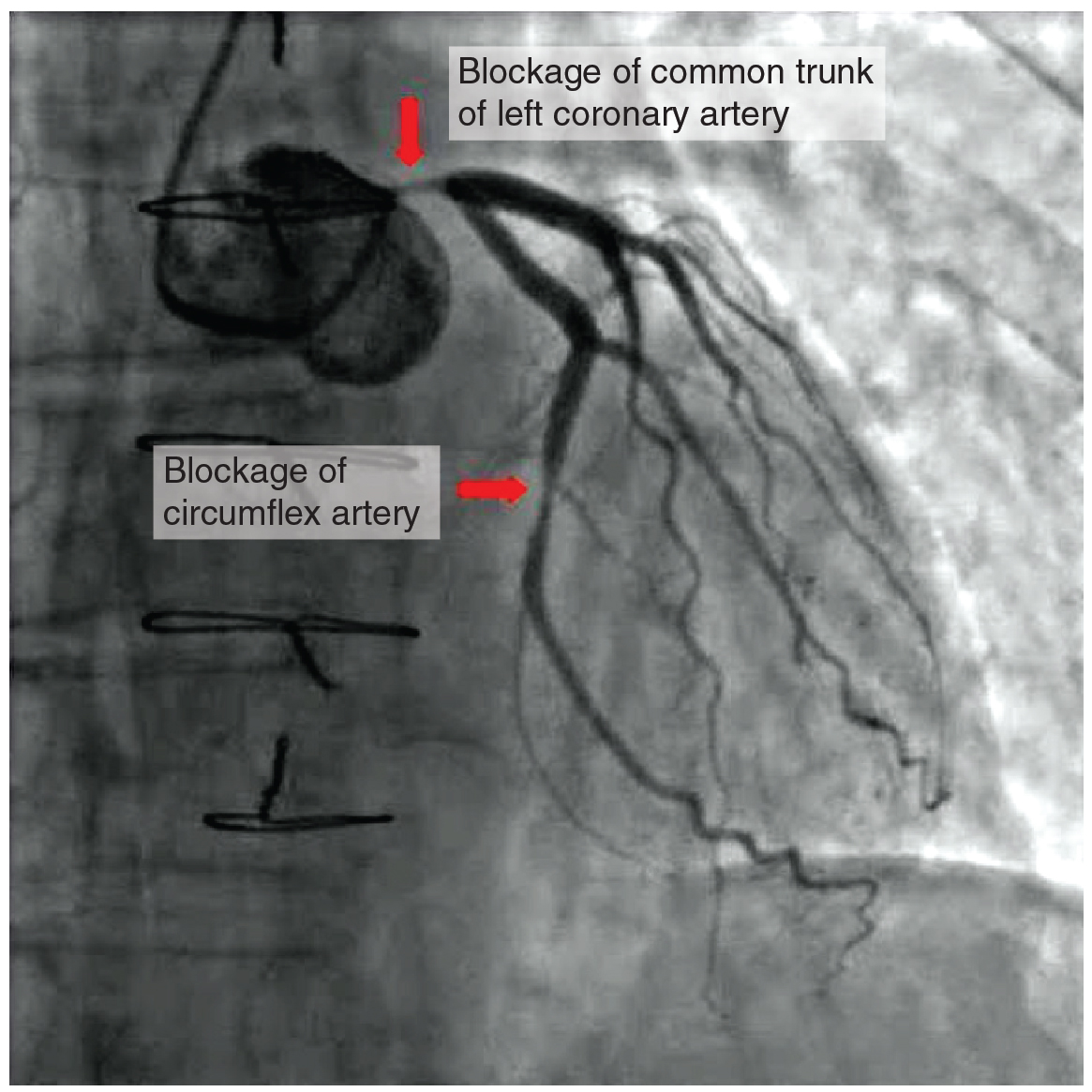 This photo shows a blockage in the coronary artery and in the circumflex artery.