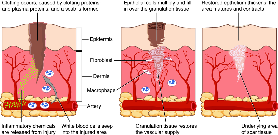 This diagram shows the wound healing process in three steps. Each step shows a cross section of wounded skin. The wound extends through the upper layer of skin, labeled the epidermis, about halfway through the dermis, the lower deeper layer of skin. At the base of the cross section, an artery runs horizontally through fatty tissue below the dermis. Several small capillaries branch from the artery and travel into the upper regions of the dermis. In the first step of healing, inflammatory chemicals, symbolized with green dots, are released from the injury site. The chemicals travel through the dermis and enter the horizontal artery. Clotting proteins and plasma proteins also initiate clotting within the wound, forming a scab, which is clearly visible in the second step as a black and brown mass covering the upper regions of the wound. Below the scab, epithelial cells in the epidermis multiply and begin to fill in the wound. In the dermis, three fibrocytes are binding the wound area with white tissue. This tissue is granulation tissue. Laying down granulation tissue restores the vascular supply, as indicated by capillaries growing around the wounded area. In the third step, the scab is gone and the epidermis has grown in and contracted to seal the upper portion of the wound. In the deeper regions, the wound is now completely filled with granulation tissue with is now considered scar tissue.