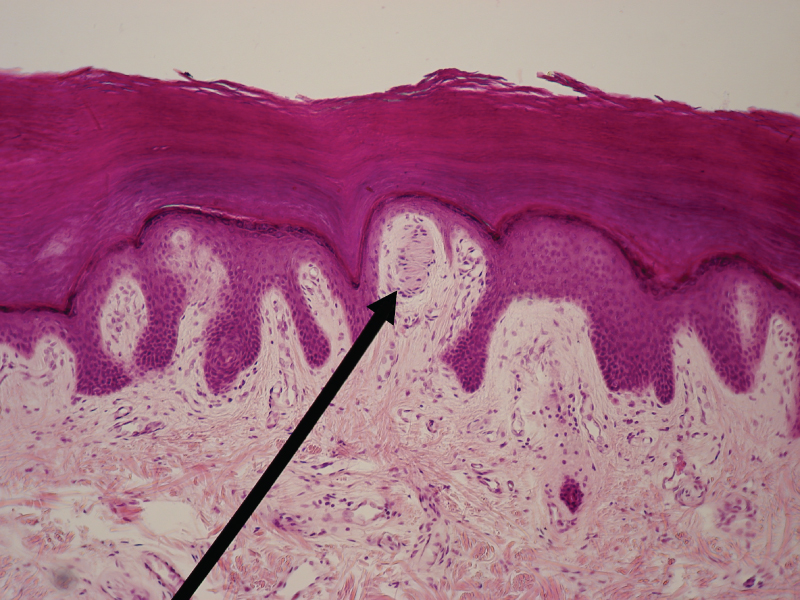 This micrograph shows a skin cross section at low magnification. The Meissner’s corpuscle is a large, oval-shaped structure located in the papillary layer of the dermis, under the lowest deepest layer of the epidermis. The corpuscle contains a dark staining oval within the outer, light staining oval. Several horizontal bars are arranged vertically within the inner oval. Also, several cells with dark purple nuclei can be seen scattered throughout the corpuscle.