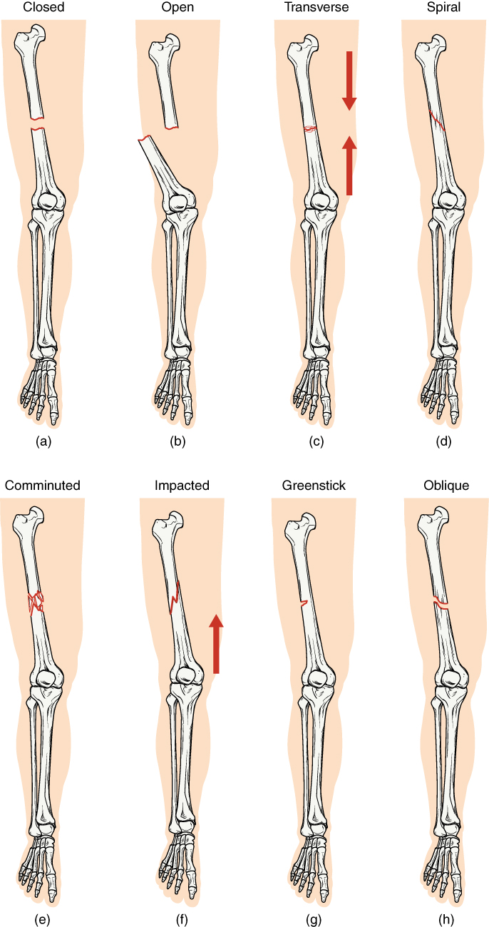 In this illustration, each type of fracture is shown on the right femur from an anterior view. In the closed fracture, the femur is broken in the middle of the shaft with the upper and lower halves of the bone completely separated. However, the two halves of the bones are still aligned in that the broken edges are still facing each other. In an open fracture, the femur is broken in the middle of the shaft with the upper and lower halves of the bone completely separated. Unlike the closed fracture, in the open fracture, the two bone halves are misaligned. The lower half is turned laterally and it has protruded through the skin of the thigh. The broken ends no longer line up with each other. In a transverse fracture, the bone has a crack entirely through its width, however, the broken ends are not separated. The crack is perpendicular to the long axis of the bone. Arrows indicate that this is usually caused by compression of the bone in a superior-inferior direction. A spiral fracture travels diagonally through the diameter of the bone. In a comminuted fracture, the bone has several connecting cracks at its middle. It is possible that the bone could splinter into several small pieces at the site of the comminuted fracture. In an impacted fracture, the crack zig zags throughout the width of the bone like a lightning bolt. An arrow indicates that these are usually caused by an impact that pushes the femur up into the body. A greenstick fracture is a small crack that does not extend through the entire width of the bone. The oblique fracture shown here is travelling diagonally through the shaft of the femur at about a thirty degree angle.