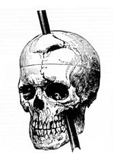 The image on the right shows a drawing of the skull with the metal spike inserted like it would have been when he was injured.