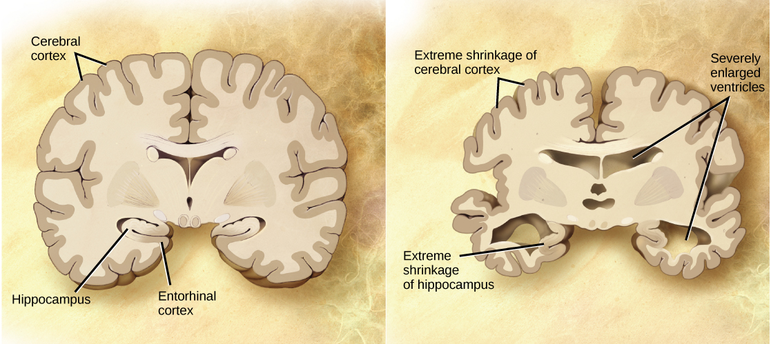 A cross section of a normal brain and the brain of an Alzheimer’s patient are compared. In the Alzheimer’s brain, the cerebral cortex is greatly shrunken in size as is the hippocampus. Ventricles, holes in the center and bottom right and left parts of the brain, are also enlarged.