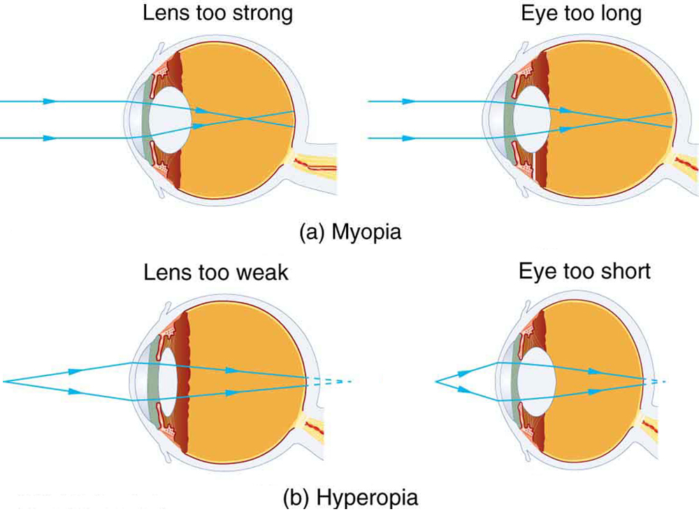 Part a shows two figures of cross-sectional area of eye depicting myopia. In both the figures, parallel rays coming from an object placed at infinity are converging in front of the retina. Figure on the left shows the lens of the eye too strong and figure on the right illustrates the shape of the eye too long. Part b shows two figures of cross-sectional area of eye depicting hyperopia. In both the figures, rays coming from a close object are shown which are converging at the back of the retina. Figure on the left shows the lens of the eye too weak and figure on the right illustrates the shape of the eye too short.