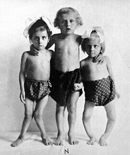 Children with Rickets