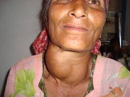 Woman with large goiter on neck