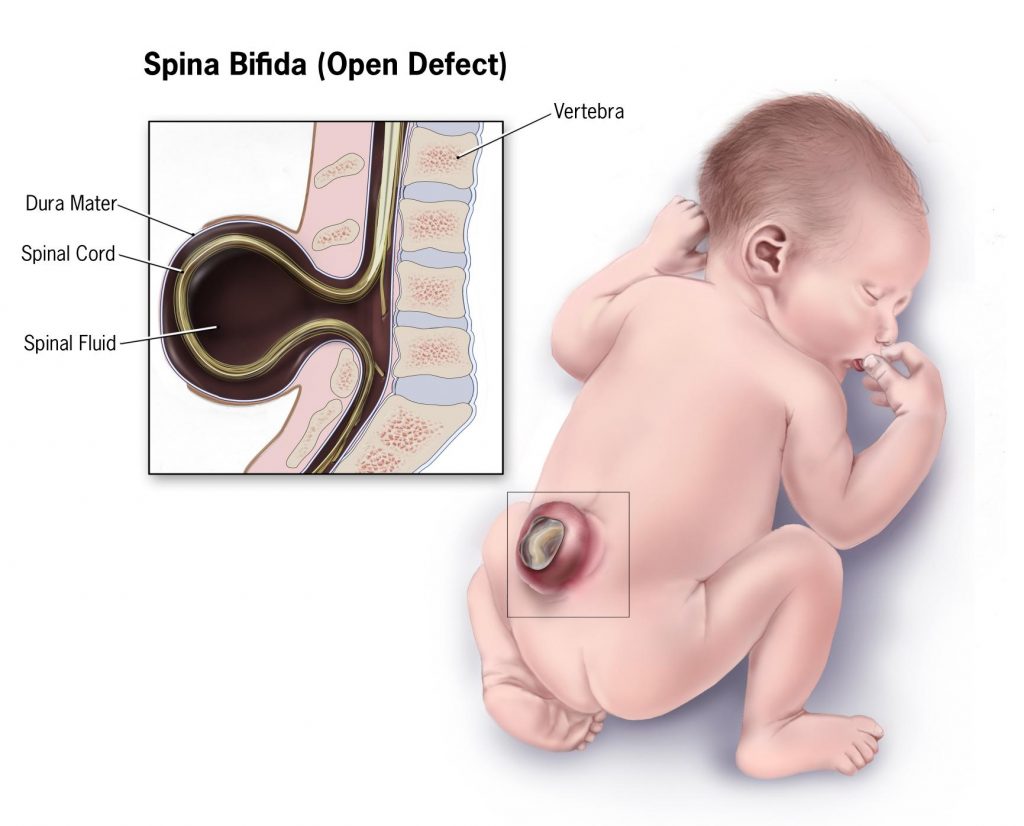 An illustration of an infant with Spina Bifida