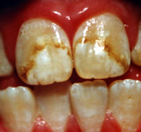 Teeth with discoloration due to Bellingham fluorosis