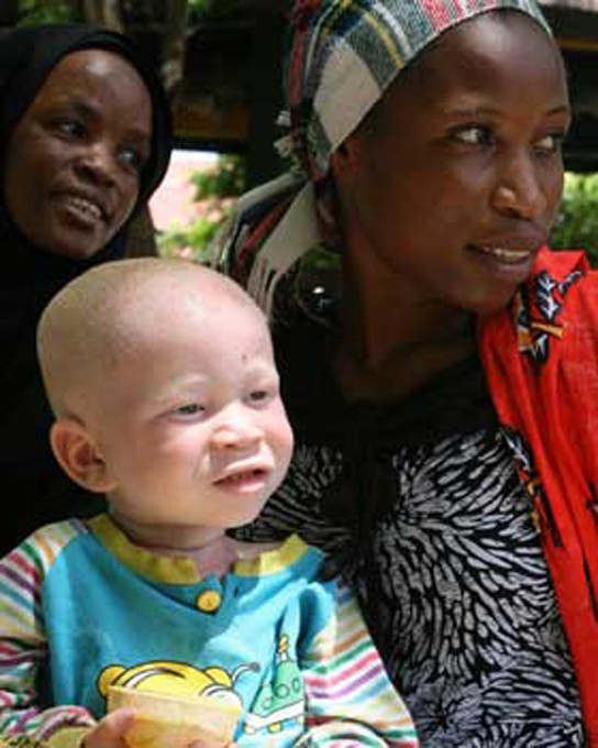 Image of an albino human child.