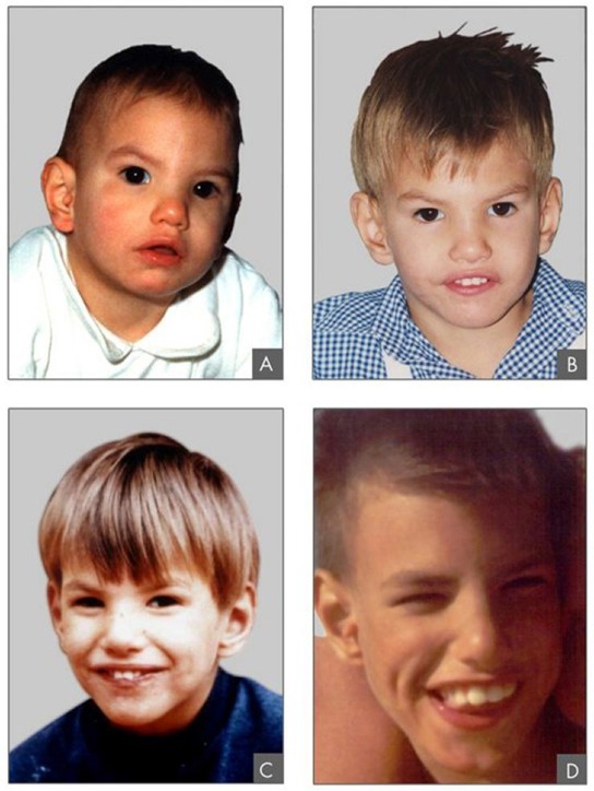 Pictures of a child with cri-du-chat syndrome at ages 2, 4, 9, and 12.