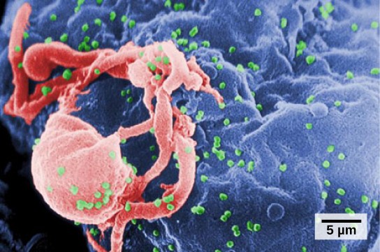 Microscope image of an HIV infection budding from a lymphocyte cell.