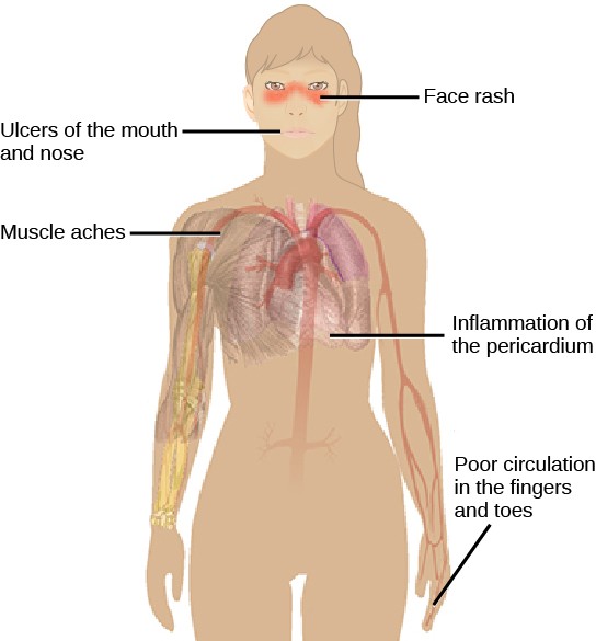 Diagram of the symptoms of lupus including: face rash, ulcers of the mouth and nose, muscle aches, inflammation of the pericardium, and poor circulation in the fingers and toes.